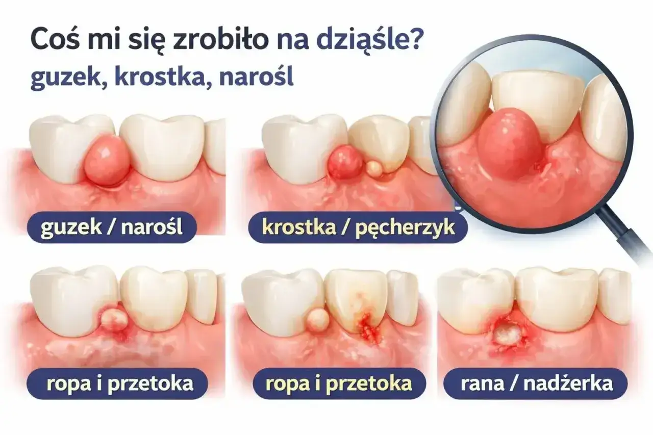 Ilustracja pokazuje różne zmiany na dziąśle: guzek, krostkę, ropień i ranę. Włókniak na dziąśle może przybierać różne formy.