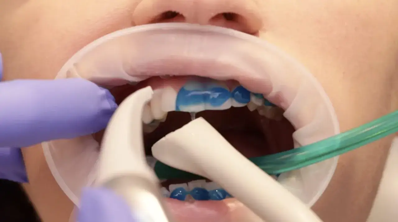 Dentysta nakłada żel na zęby, przygotowując je do założenia aparatu. Czas zakładania aparatu jest krótki.