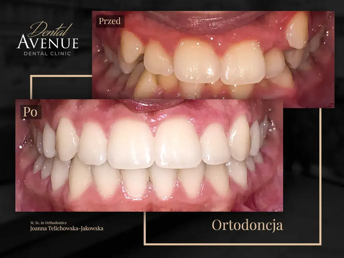 Aparat estetyczny przed i po: krzywe zęby wyprostowane, uśmiech odmieniony. Ortodoncja w Dental Avenue.