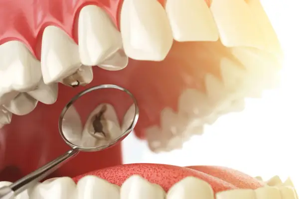 Widok jamy ustnej z lusterkiem dentystycznym pokazującym ubytek, który wymaga wypełnienia. Plomba chemoutwardzalna to rozwiązanie dla tego problemu.