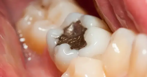 Zbliżenie na ząb z ciemną, metaliczną plombą. Widać też zdrowe, białe zęby i różowe dziąsło.
