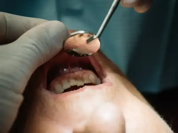 Dentysta używa lusterka, by sprawdzić, co wyciąga ropę z zęba.