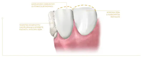 Bonding na zęby: warstwa kompozytu koryguje kształt i kolor zęba, przywracając mu idealną koronę.