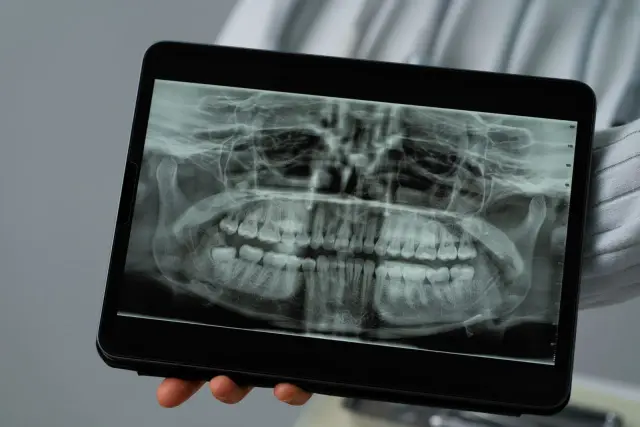 Rentgen szczęki na tablecie. Dentysta analizuje obraz, zastanawiając się, ile korzeni ma ząb 8.