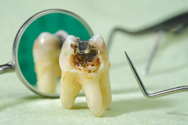 Zepsuty ząb z widocznymi dziurami w zębach, odbity w lusterku dentystycznym, obok narzędzi stomatologicznych.