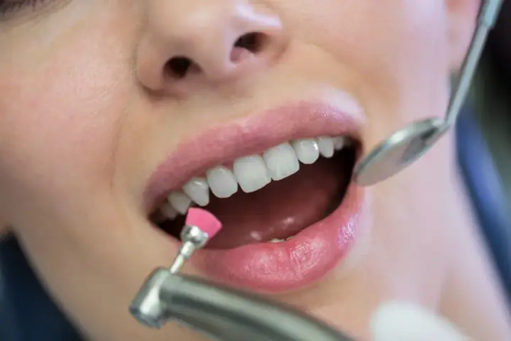 Profesjonalne usuwanie kamienia nazębnego. Dentysta poleruje zęby pacjentki małą, różową szczoteczką.