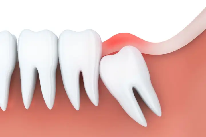 Zapalenie dziąseł wokół ósemki. Czy ósemki się leczy? Czasem wymagają interwencji dentysty.