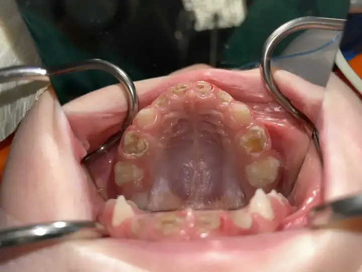 Zaawansowana próchnica zniszczyła zęby, pozostawiając ubytki i przebarwienia. Widoczne są narzędzia dentystyczne.